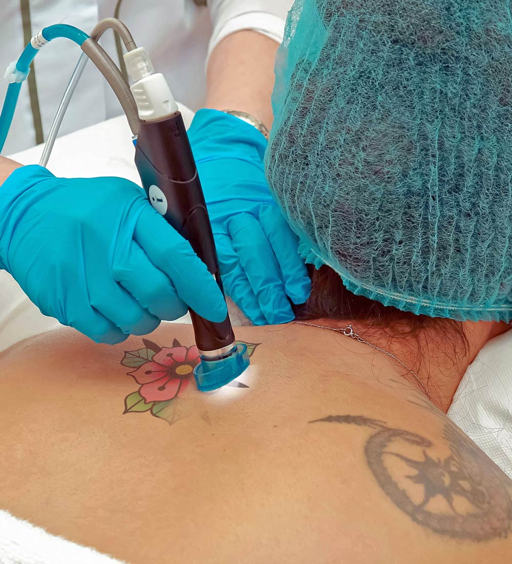 Laser Tattoo removal by Cannock Hair and Beauty